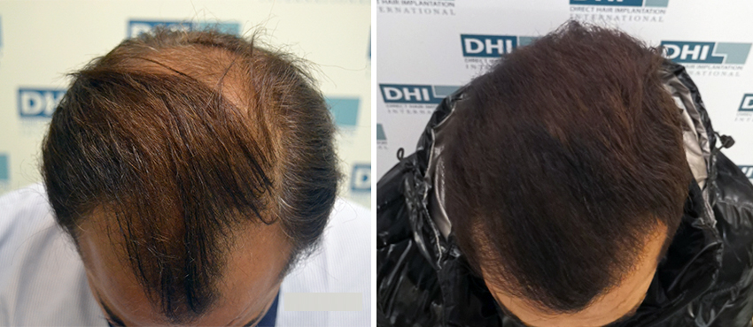 DHI before & after hair transplant results