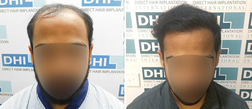 DHI before & after hair transplant results