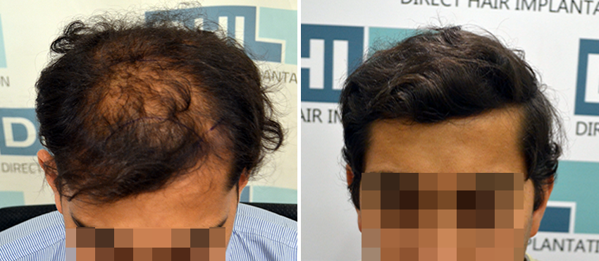 DHI before & after hair transplant results