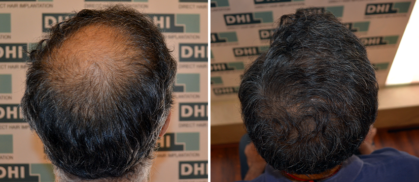 DHI before & after hair transplant results