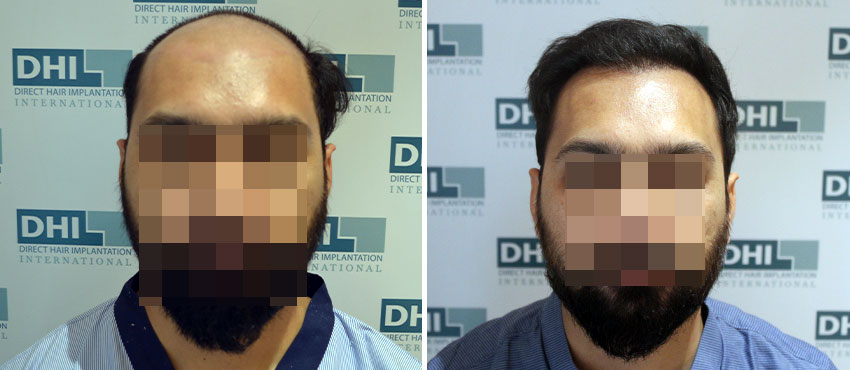 DHI before & after hair transplant results