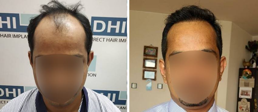 DHI before & after hair transplant results