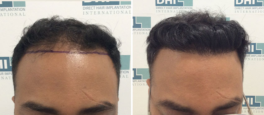 DHI before & after hair transplant results