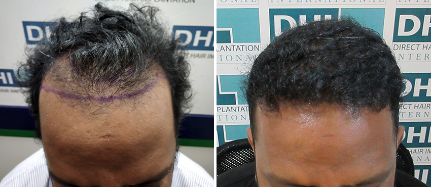 DHI before & after hair transplant results