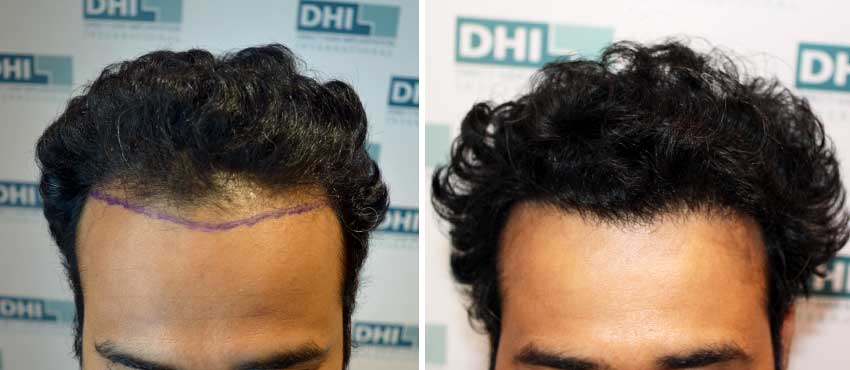 DHI before & after hair transplant results