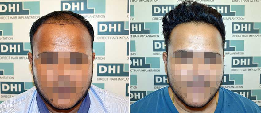 DHI before & after hair transplant results