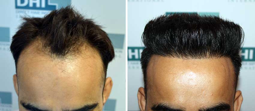 DHI before & after hair transplant results