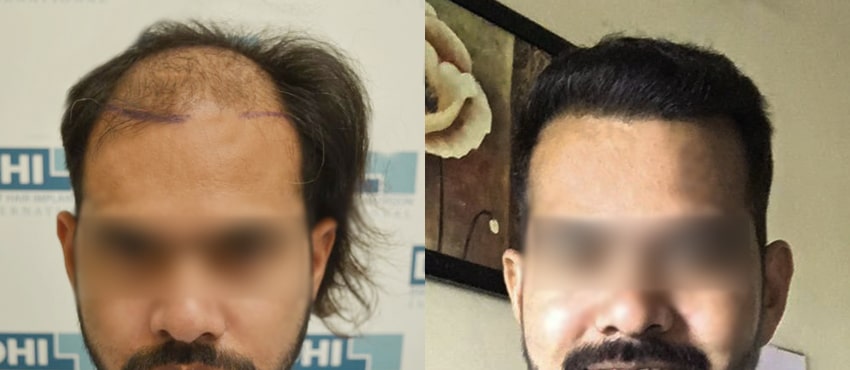 DHI before & after hair transplant results