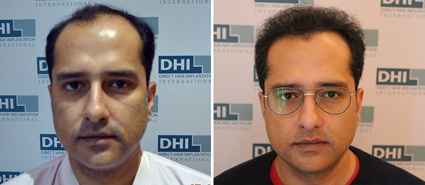 DHI before & after hair transplant results