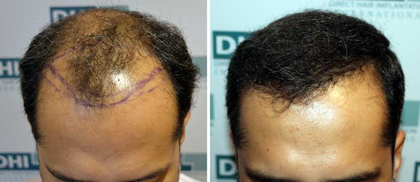 DHI before & after hair transplant results