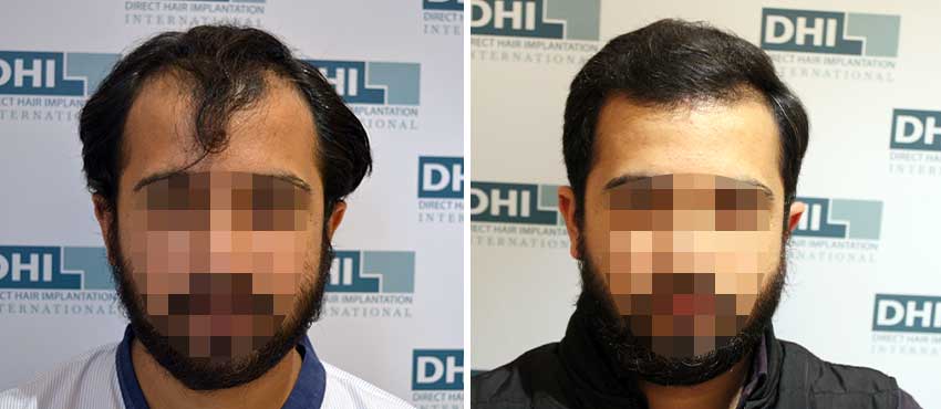 DHI before & after hair transplant results