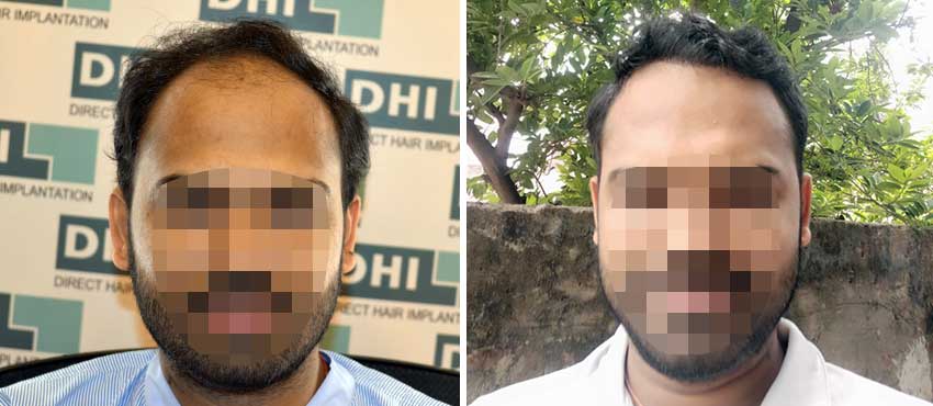 DHI before & after hair transplant results