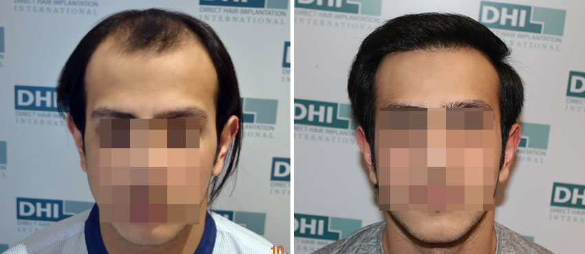 DHI before & after hair transplant results