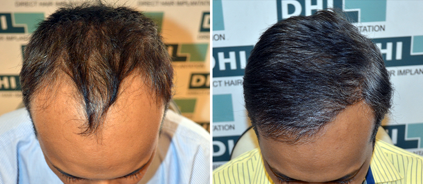 DHI before & after hair transplant results