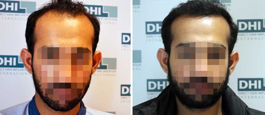 DHI before & after hair transplant results