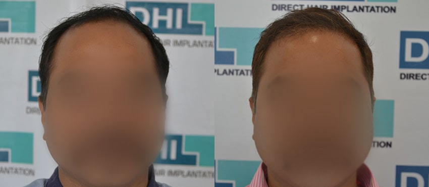 DHI before & after hair transplant results