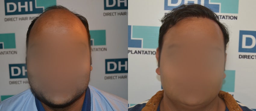 DHI before & after hair transplant results