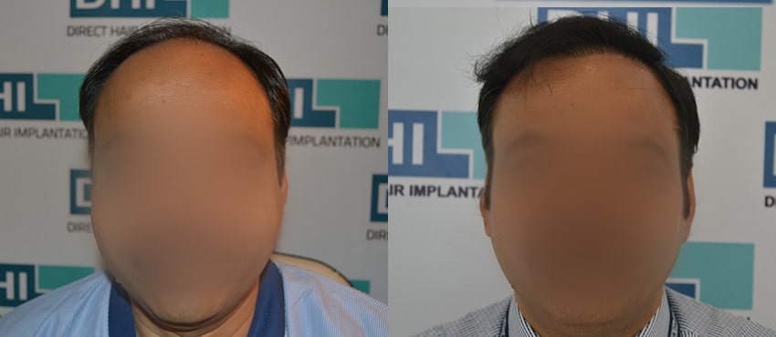 DHI before & after hair transplant results