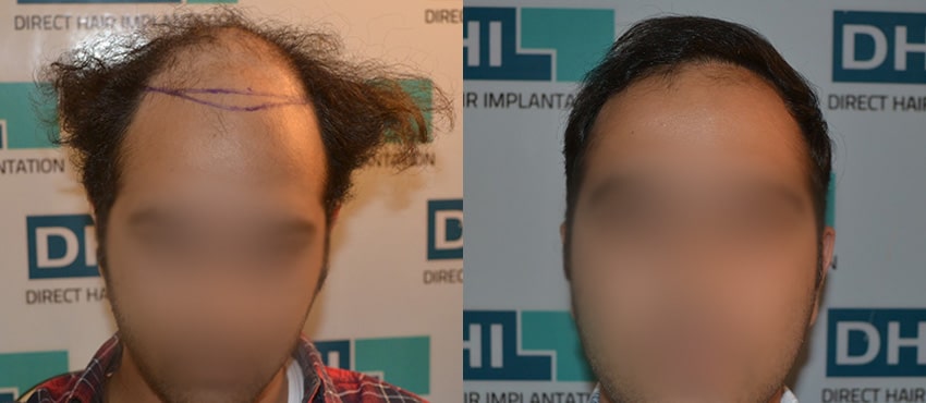 DHI before & after hair transplant results