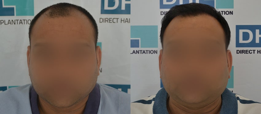 DHI before & after hair transplant results