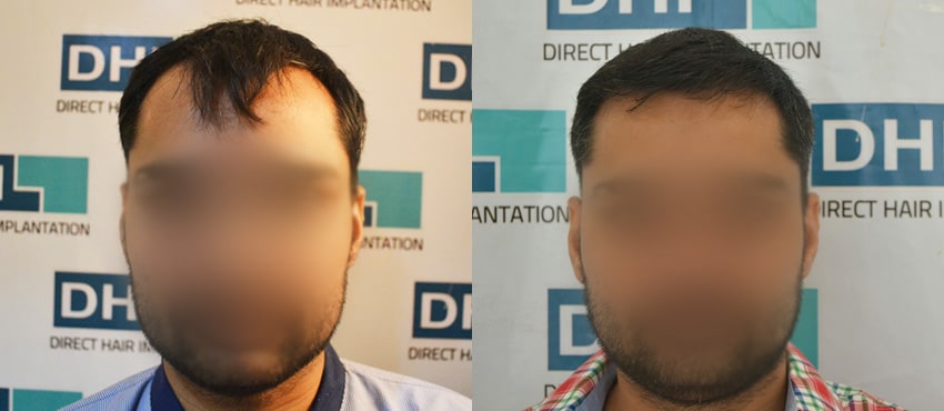 DHI before & after hair transplant results