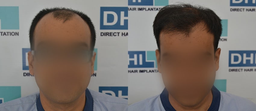 DHI before & after hair transplant results