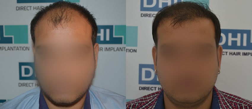 DHI before & after hair transplant results