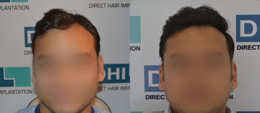 DHI before & after hair transplant results