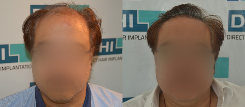 DHI before & after hair transplant results