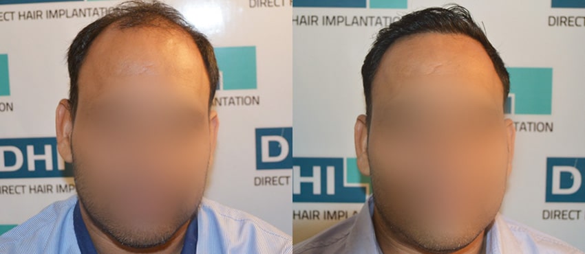 DHI before & after hair transplant results