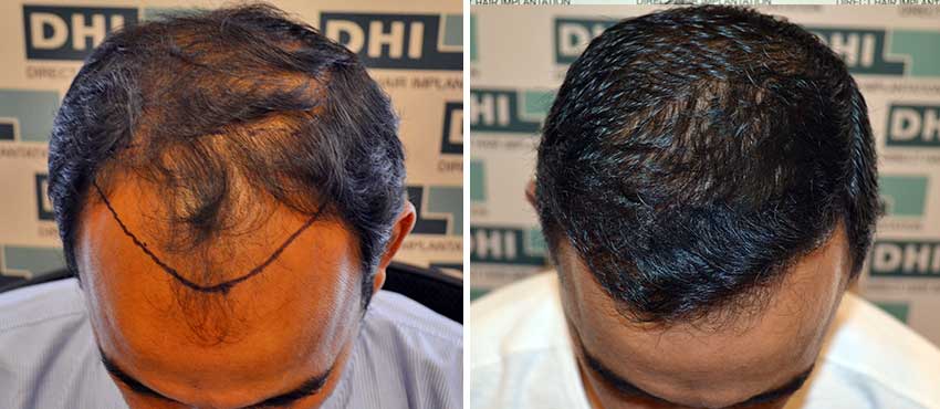 DHI before & after hair transplant results