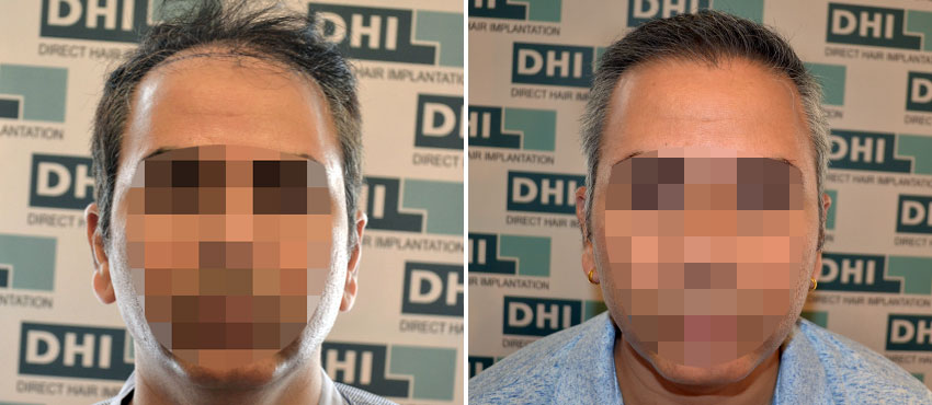 DHI before & after hair transplant results