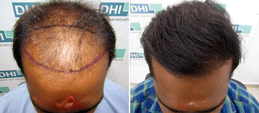 DHI before & after hair transplant results