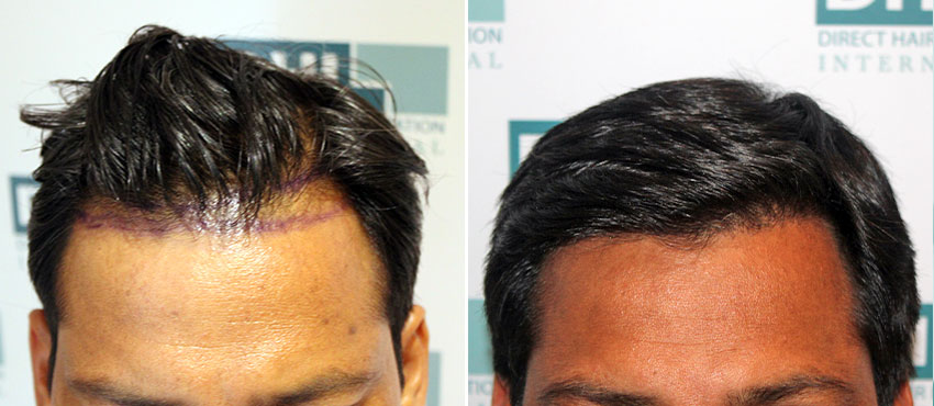 DHI before & after hair transplant results