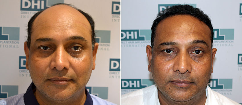 DHI before & after hair transplant results