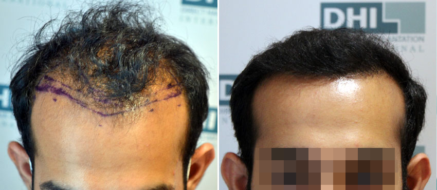 DHI before & after hair transplant results