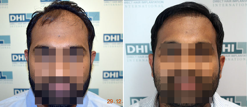 DHI before & after hair transplant results