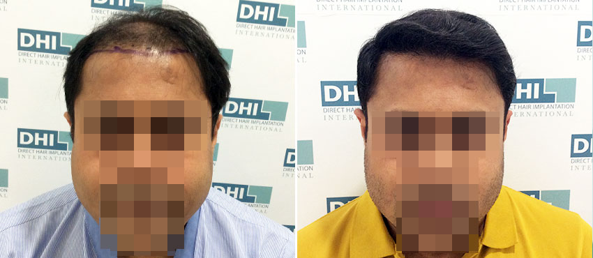 DHI before & after hair transplant results