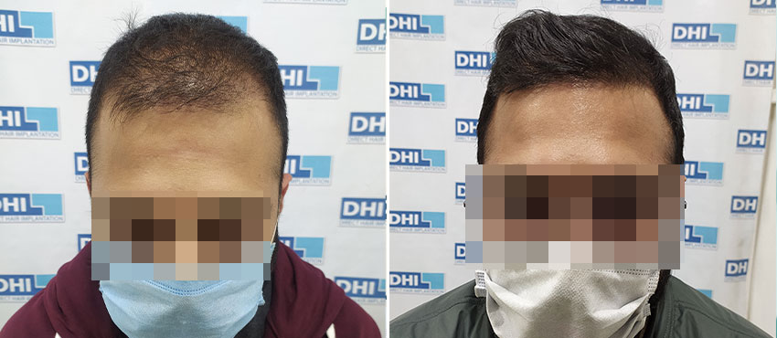 DHI before & after hair transplant results