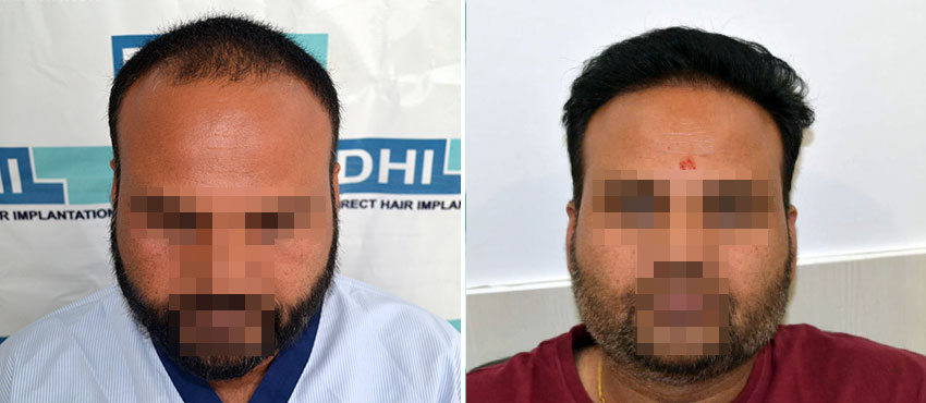 DHI before & after hair transplant results