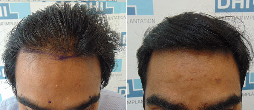 DHI before & after hair transplant results