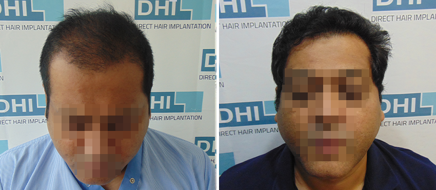 DHI before & after hair transplant results