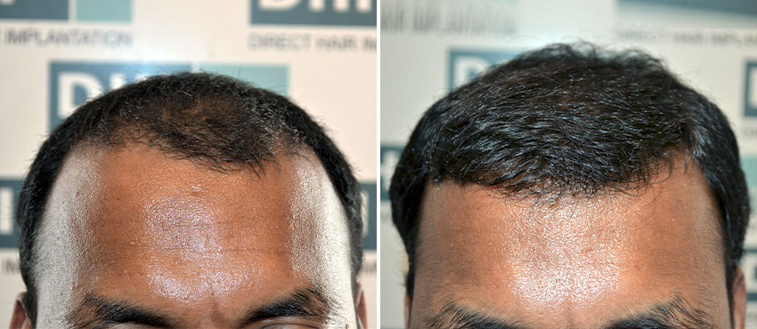 DHI before & after hair transplant results