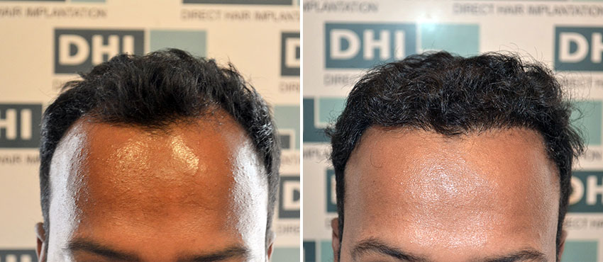 DHI before & after hair transplant results