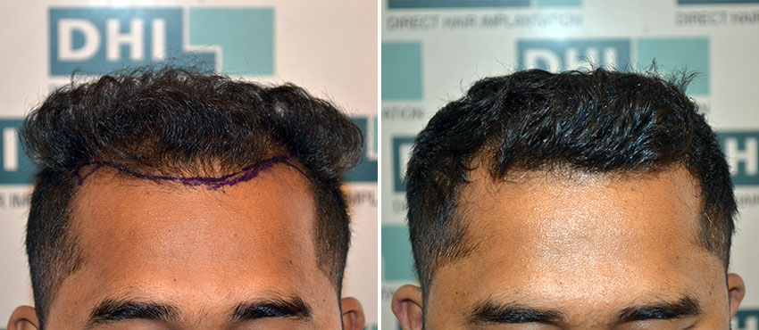 DHI before & after hair transplant results