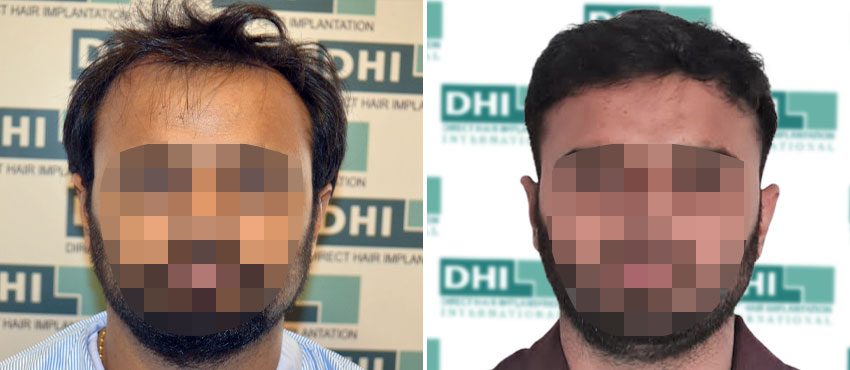 DHI before & after hair transplant results