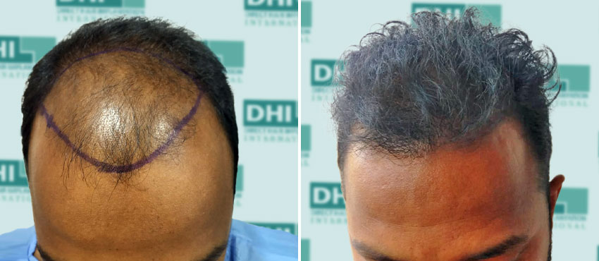 DHI before & after hair transplant results