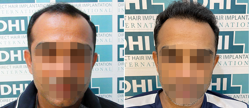 DHI before & after hair transplant results