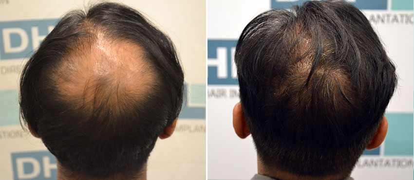 DHI before & after hair transplant results