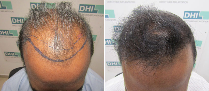 DHI before & after hair transplant results